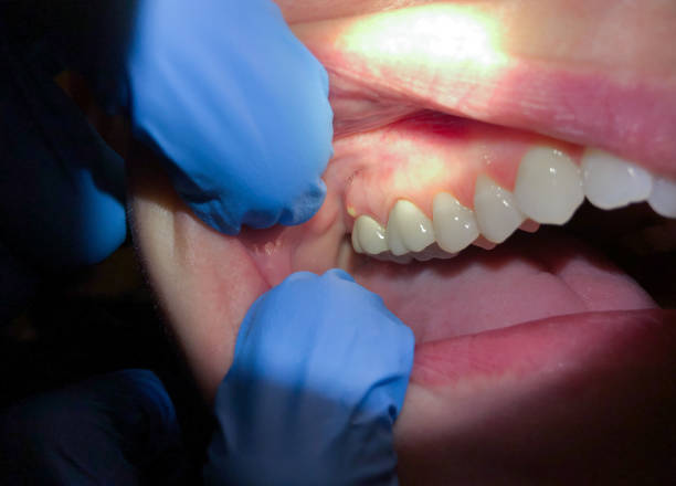 Best Emergency Dental Care for Broken or Chipped Teeth in Wallace, ID