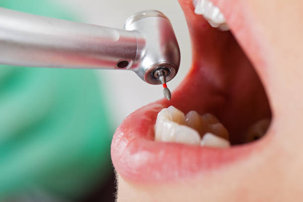Best Emergency Wisdom Teeth Removal in Wallace, ID